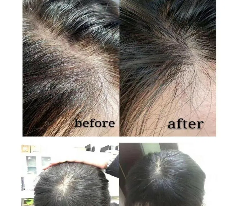 Regenerate Scalp Damagepromotes The Growth of Thicker, Stronger Hair for Dermica&reg; Hairzon - Stylo Mesotherapy/ Dermal Cegaba