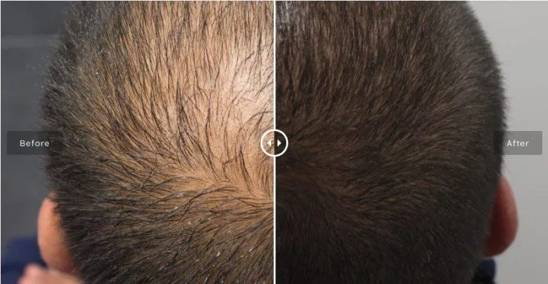Regenerate Scalp Damagepromotes The Growth of Thicker, Stronger Hair for Dermica&reg; Hairzon - Stylo Mesotherapy/ Dermal Cegaba