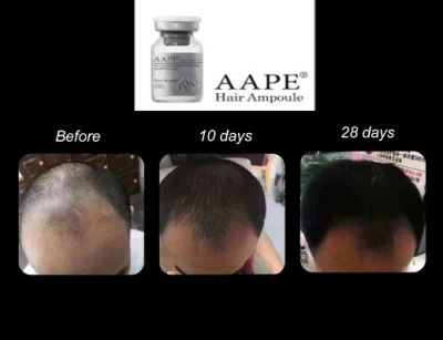 Aape Promotes Hair Growth Anti Hair Loss to Grow Hair for Alopecia Male and Female Hair Loss Aape